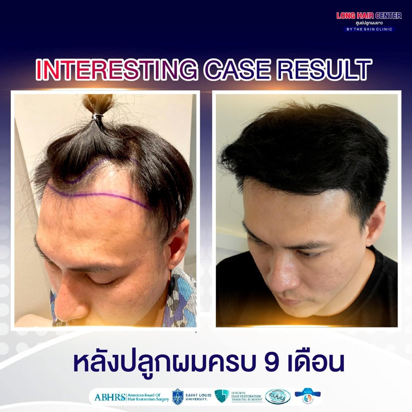 ปัญหาผมบาง, ปลูกผมที่ไหนดี, ศัลยกรรมปลูกผม