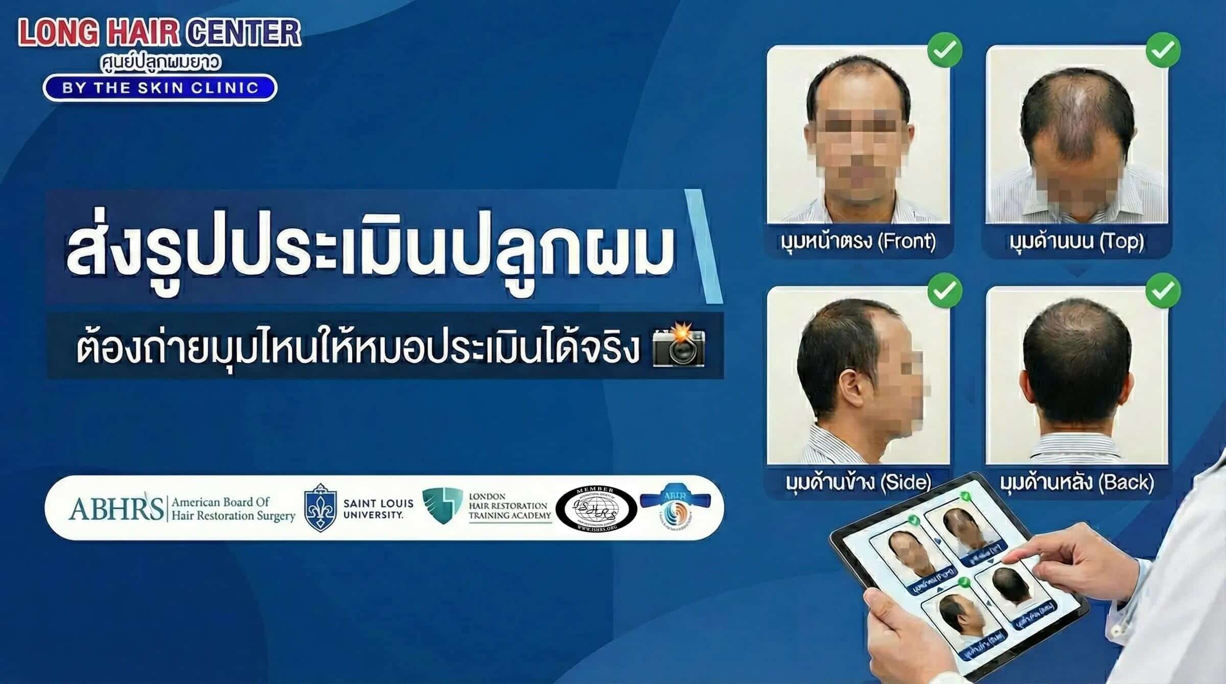 คู่มือถ่ายรูปส่งประเมินปลูกผมก่อนปรึกษาแพทย์