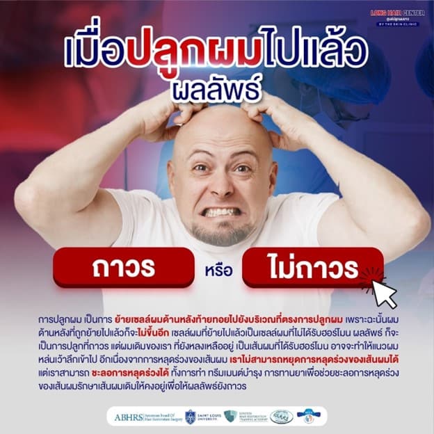 ปลูกผมถาวร