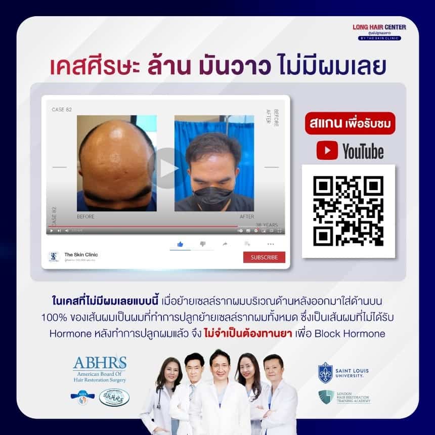 กรณีที่ศีรษะล้านมากจนไม่เหลือเส้นผมกลางศีรษะเลย ทำการรักษาโดยการปลูกผม แบบนี้ ไม่จำเป็นต้องทานยา เพราะเป็นการนำผมด้านหลังมาปลูกแทนบริเวณที่ไม่มีผมทั้งหมด