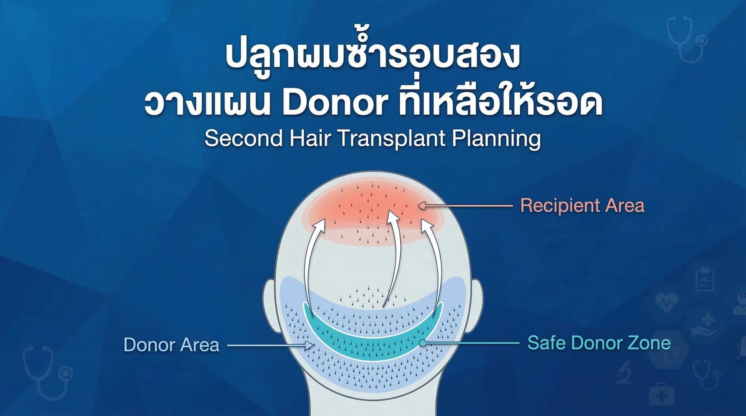 ปลูกผมซ้ำรอบสอง: วางแผน Donor ที่เหลือให้รอด