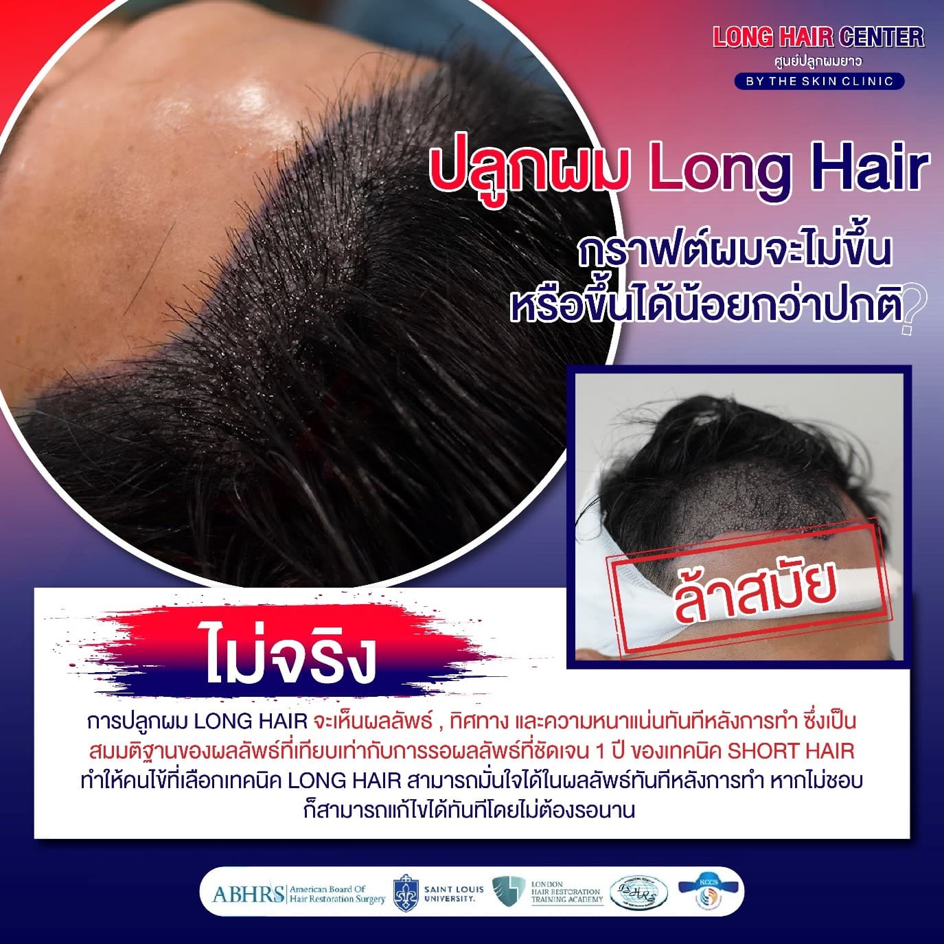 ปลูกผม Long Hair กราฟต์ผมจะไม่ขึ้น หรือขึ้นได้น้อยกว่าปกติ