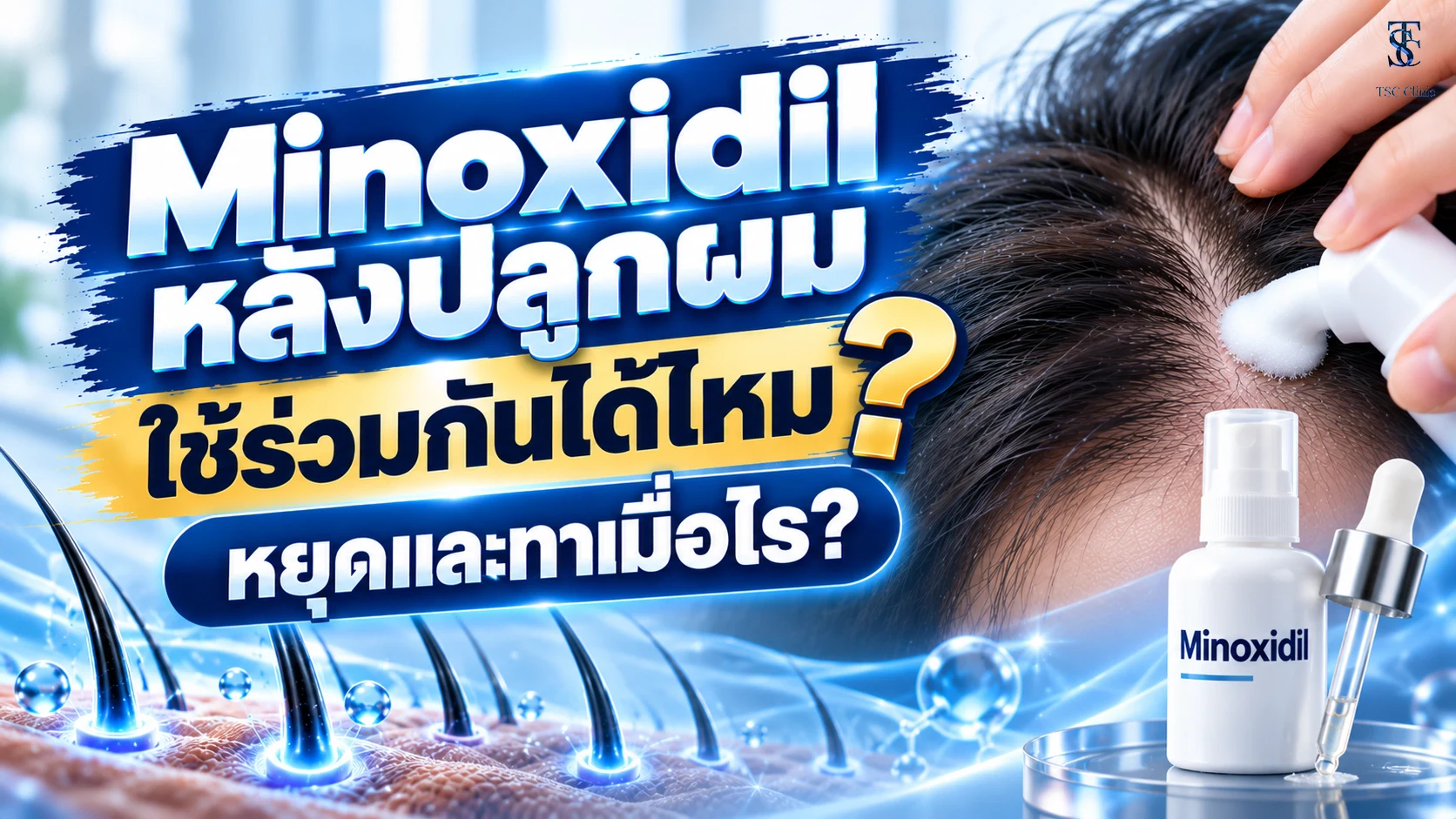 Minoxidil หลังปลูกผม ใช้ร่วมกันได้ไหม? หยุดและทาเมื่อไร