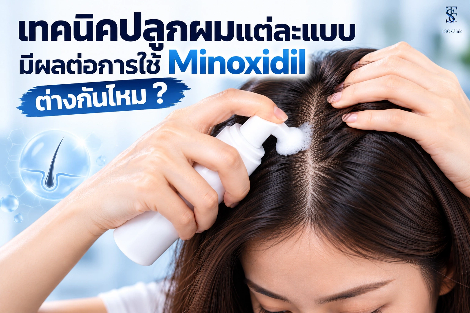 การแหวกผมทายาโฟม Minoxidil บนหนังศีรษะหลังปลูกผมแบบไม่โกน