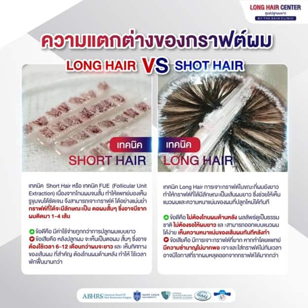 ลักษณะเส้นผมที่ต่างกัน ใช้กราฟต์ต่างกันไหม?