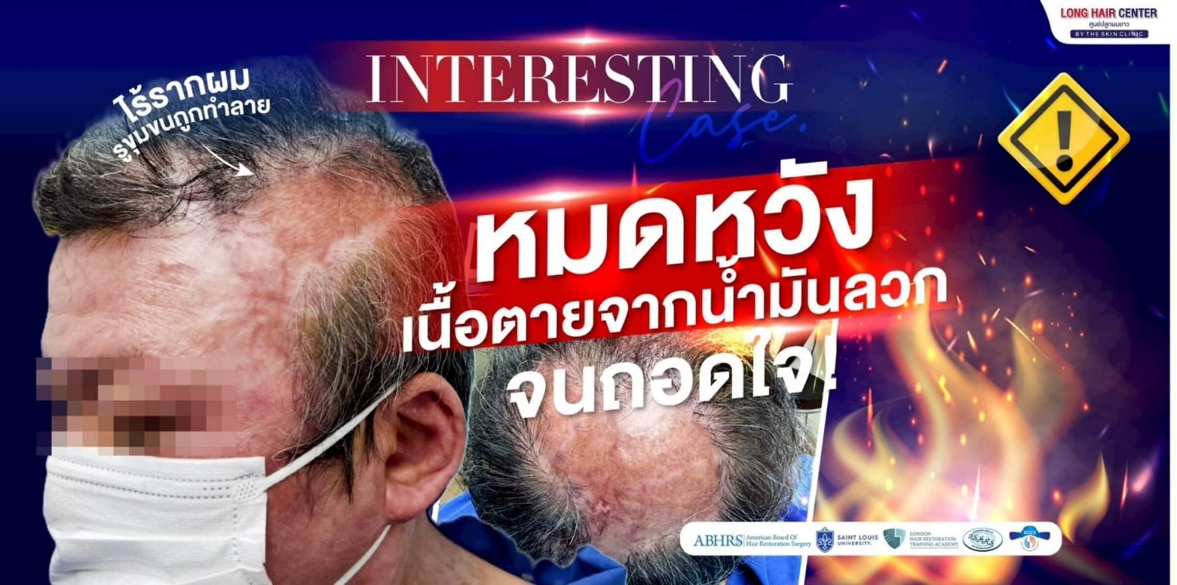 ปลูกผมบนแผลเป็น เนื้อตาย เป็นไปได้จริงหรือ? เปิดเคสพลิกชีวิต หัวล้านจากน้ำมันลวกศีรษะ!