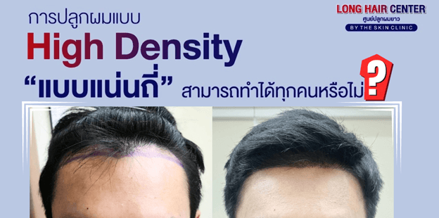 ปลูกผมแล้วต้องกินยาไปตลอดชีวิตหรือไม่?