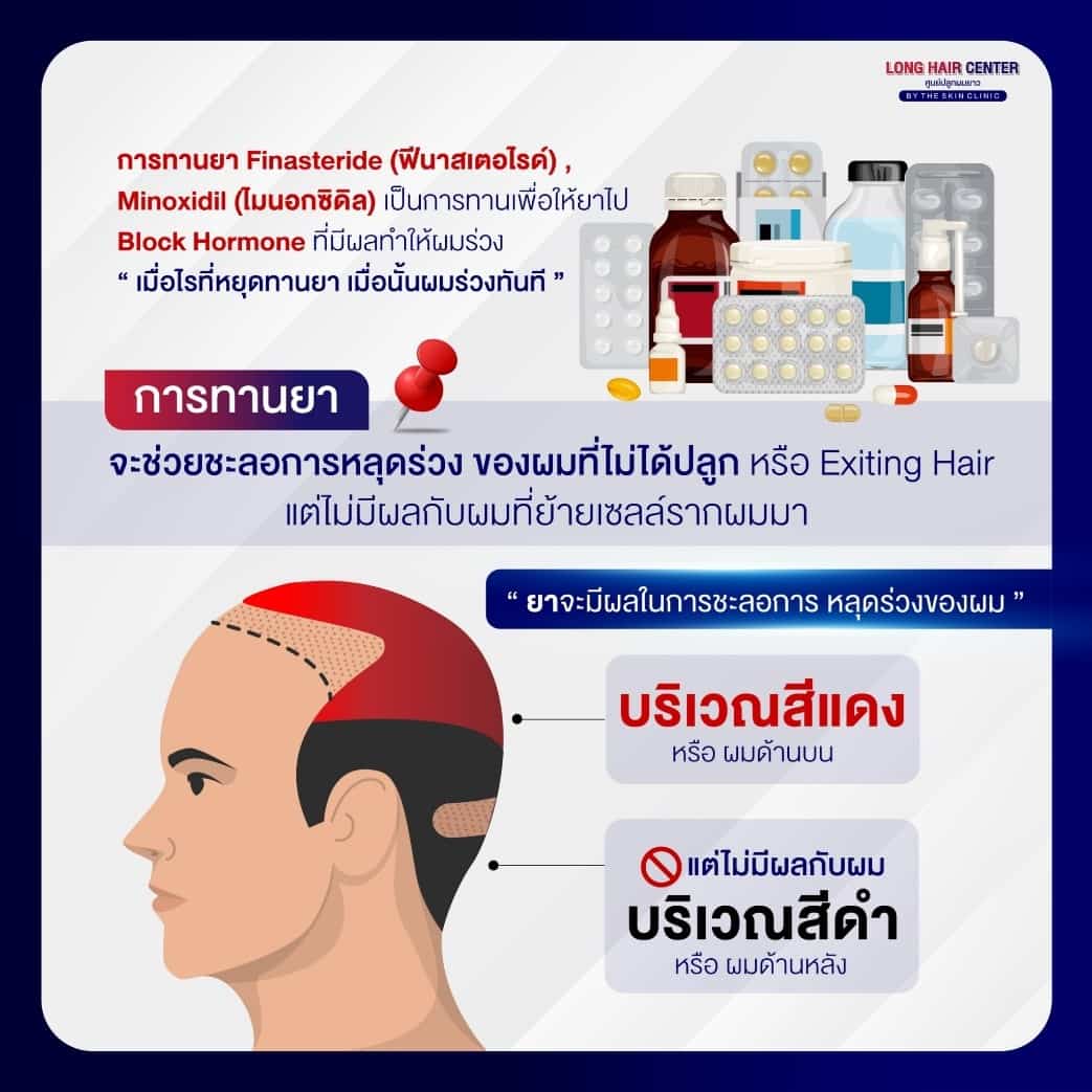 ก่อนเข้ารับการรักษาด้วยการปลูกผม หลายคนอาจสงสัยว่า“ปลูกผมแล้วต้องกินยาหรือไม่ ต้องกินตลอดชีวิตไหม ?” เพราะคิดว่าปลูกผมแล้วจะสามารถแก้ปัญหาผมบาง ศีรษะล้านได้ทั้งหมด