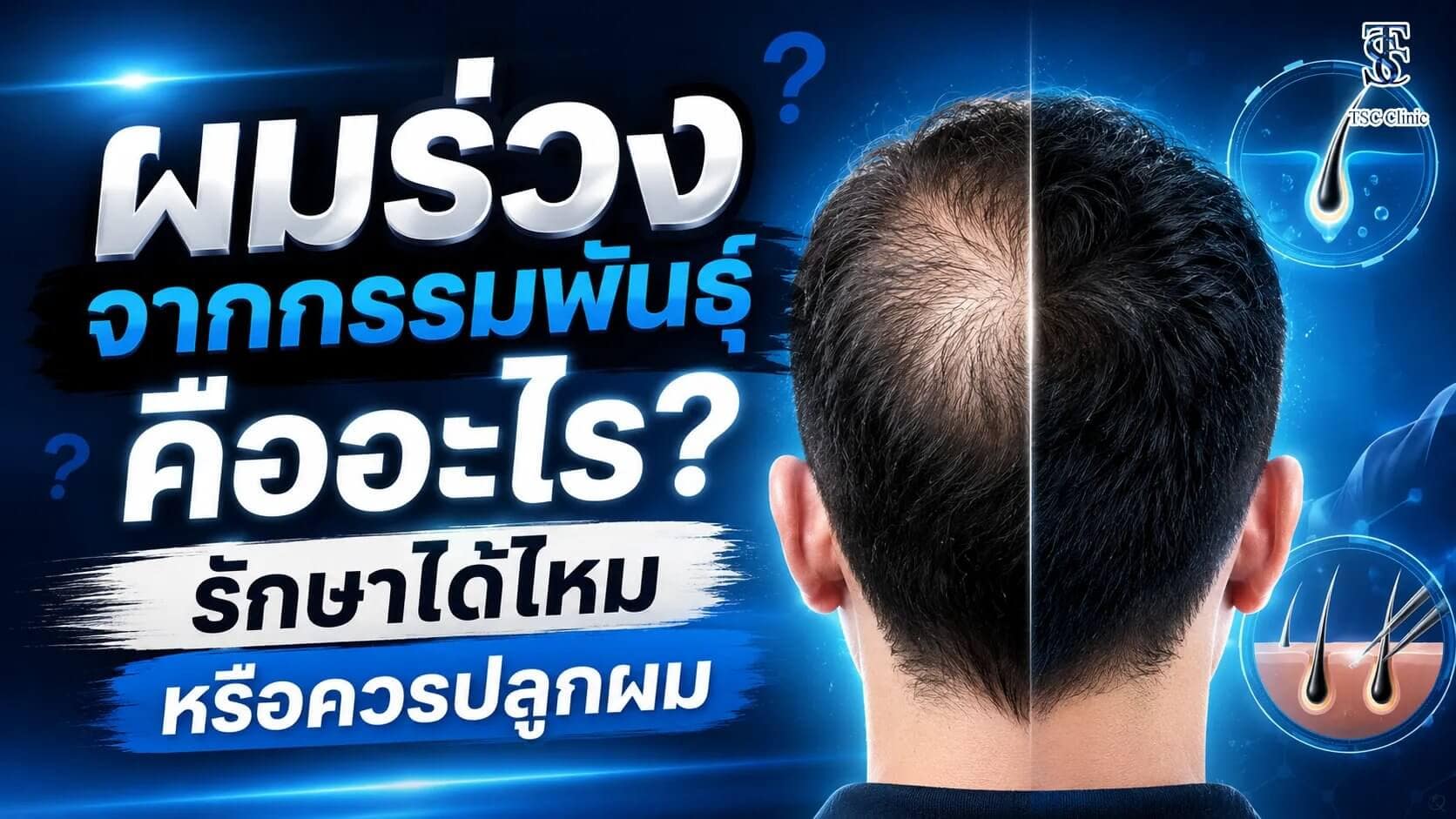 ผมร่วงจากกรรมพันธุ์ คืออะไร? รักษาได้ไหม หรือควรปลูกผม