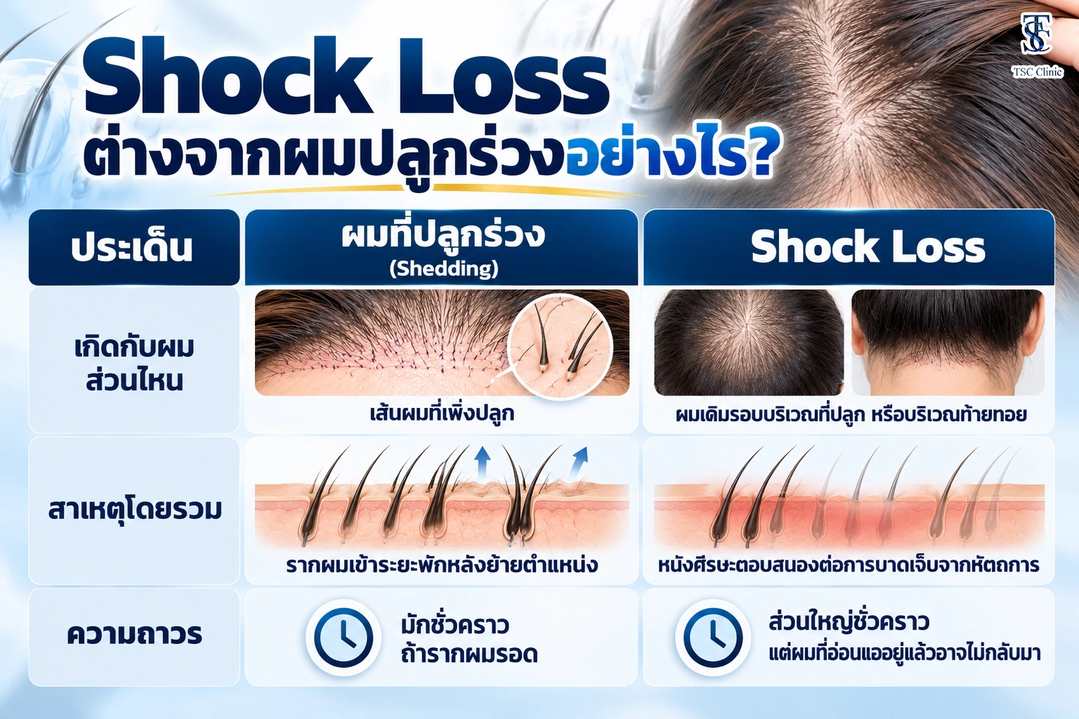 Shock Loss ต่างจากผมปลูกร่วงอย่างไร