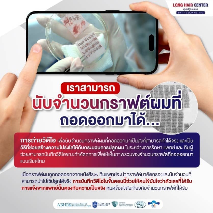 สามารถนับจำนวนกราฟต์ผมที่นำออกมาได้หรือไม่?