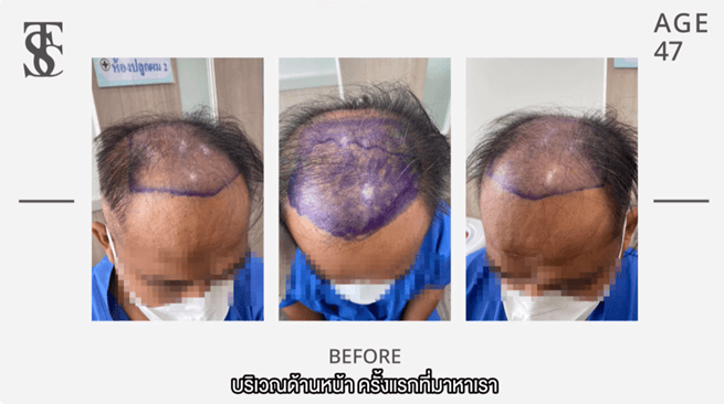 ปลูกผมที่ไหนดี, คลินิกปลูกผม