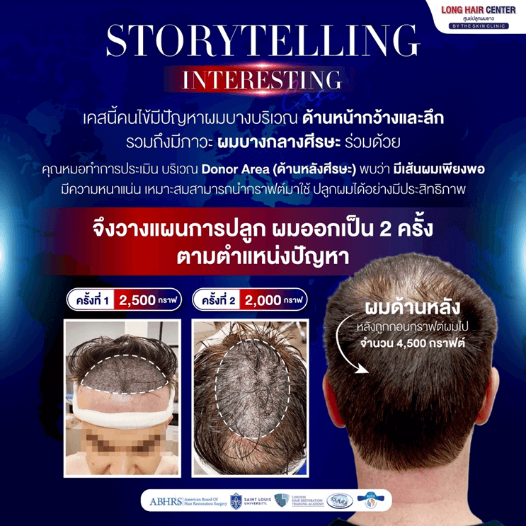 Mission Possible! รีวิวปลูกผมคนไข้เยอรมัน เปลี่ยนหัวล้านเป็นผมหนาดูดี