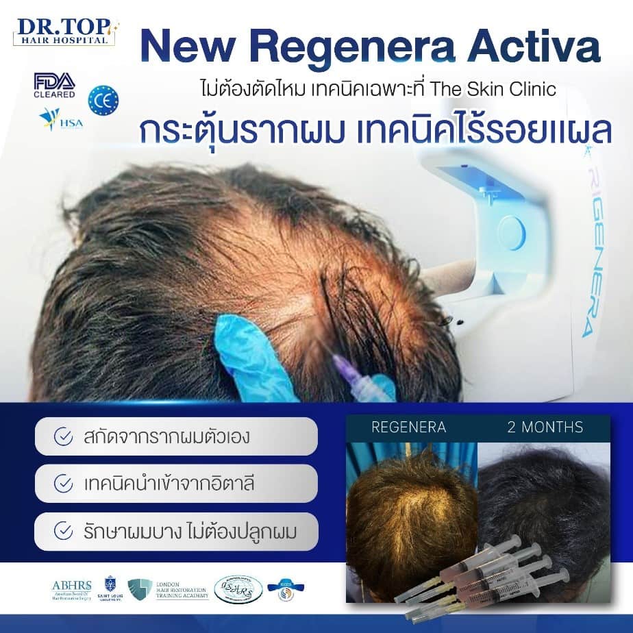 สร้างผมใหม่จากเซลล์รากผมของตัวเอง ช่วยแก้ปัญหาผมร่วงหนักมาก รากผมไม่แข็งแรง ทางเลือกสำหรับผู้ที่มีปัญหาผมร่วง ผมบาง แต่ไม่ต้องการปลูกผม เป็นการสกัด Growth Factor จากรากผมของคนไข้แล้วมาฉีดยังบริเวณหนังศีรษะที่มีปัญหา ช่วยลดผมหลุดร่วง กระตุ้นรากผม ทำให้เส้นผมหนาขึ้น