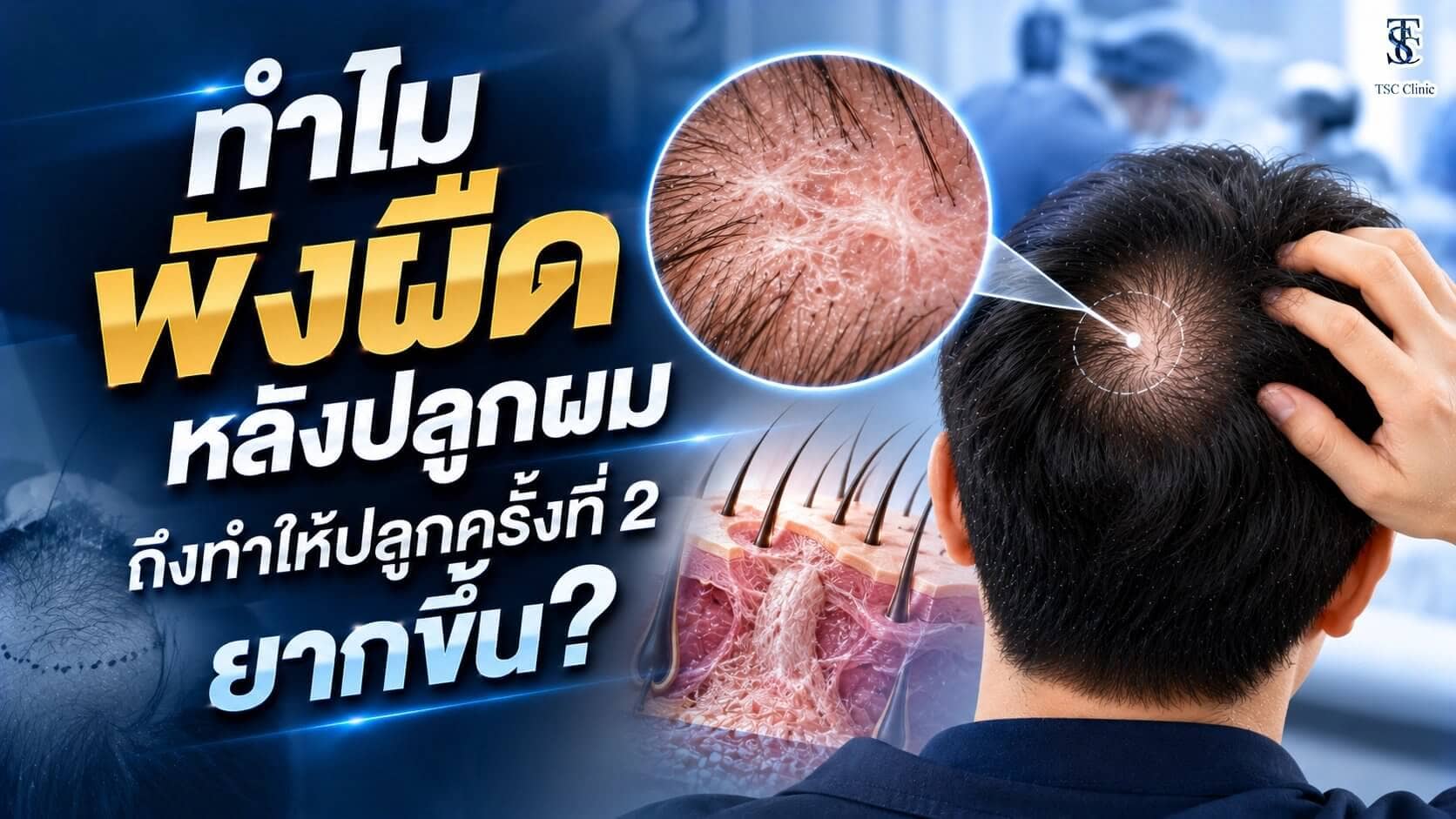 พังผืดหลังปลูกผม ทำไมปลูกผมครั้งที่ 2 ถึงยากขึ้น เตรียมหนังศีรษะด้วย ALMI Nano Fat ก่อนปลูกซ้ำ