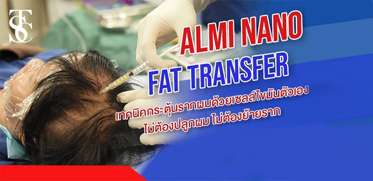 กระตุ้นรากผมด้วยเซลล์ไขมันตัวเอง ALMI NANO FAT TRANSFER