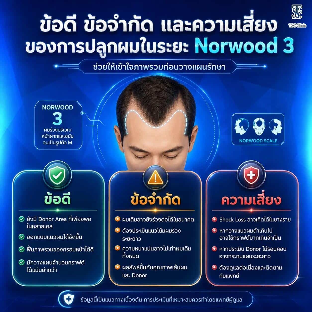 ข้อดี ข้อจำกัด และความเสี่ยงของการปลูกผมในระยะ Norwood 3