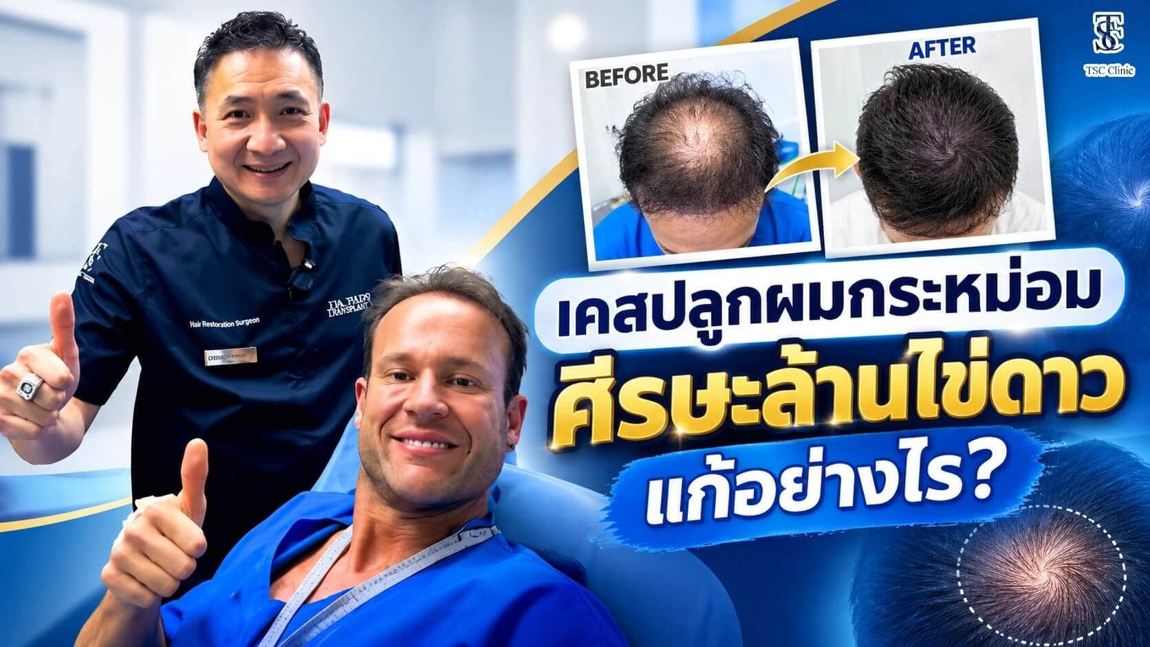 ปลูกผมกระหม่อม ศีรษะล้านไข่ดาว ก่อนและหลังทำ Long Hair FUI ร่วมกับ ALMI Nano Fat ที่ The Skin Clinic
