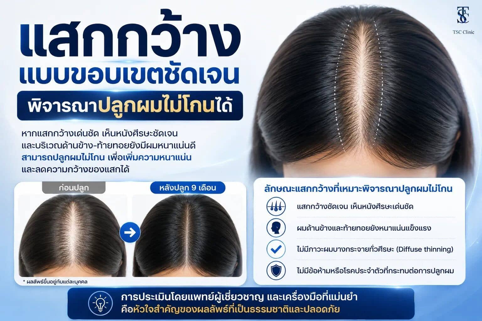 แสกกว้างแบบขอบเขตชัดเจนพิจารณาปลูกผมไม่โกนได้