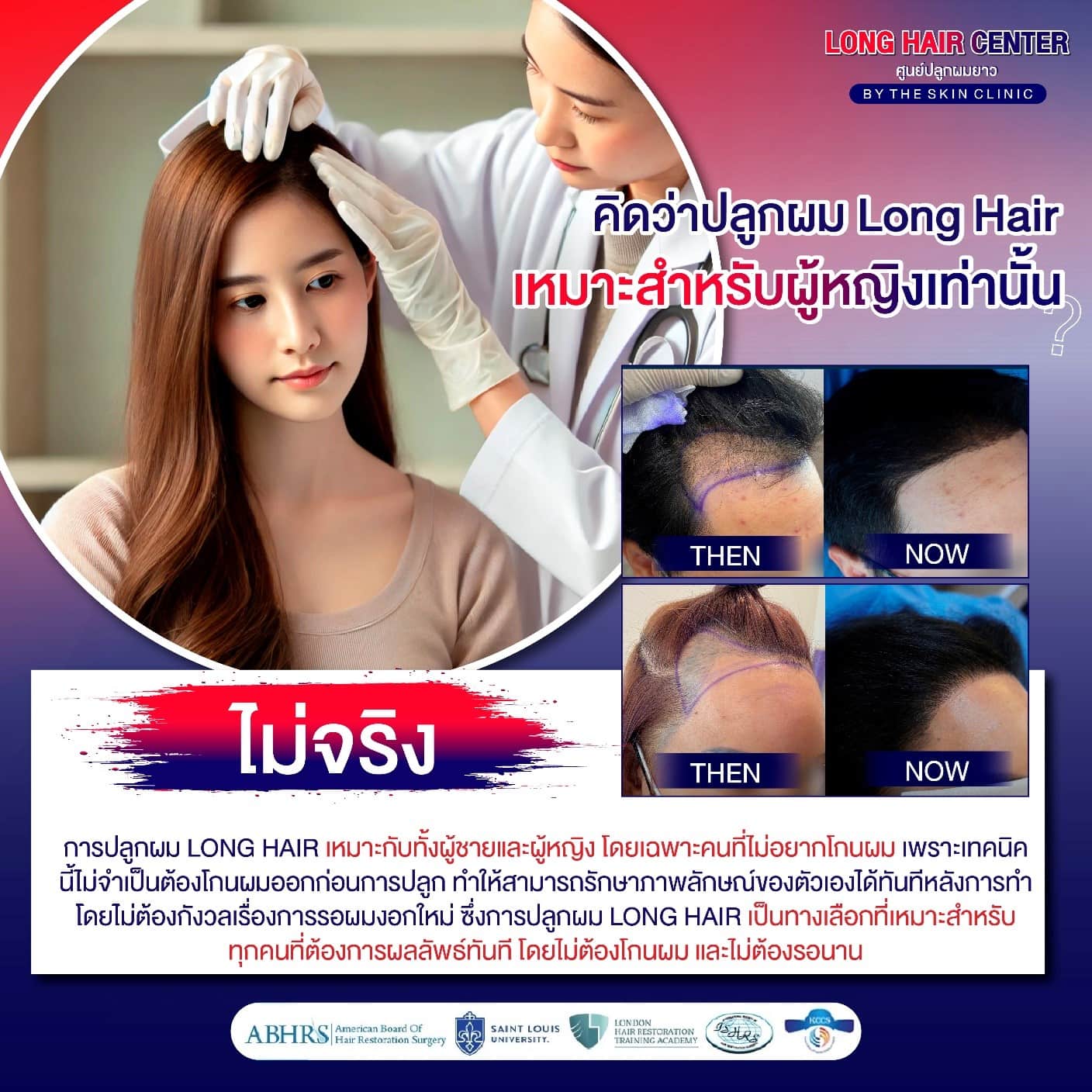 การปลูกผม Long Hair เหมาะสำหรับผู้หญิงเท่านั้น