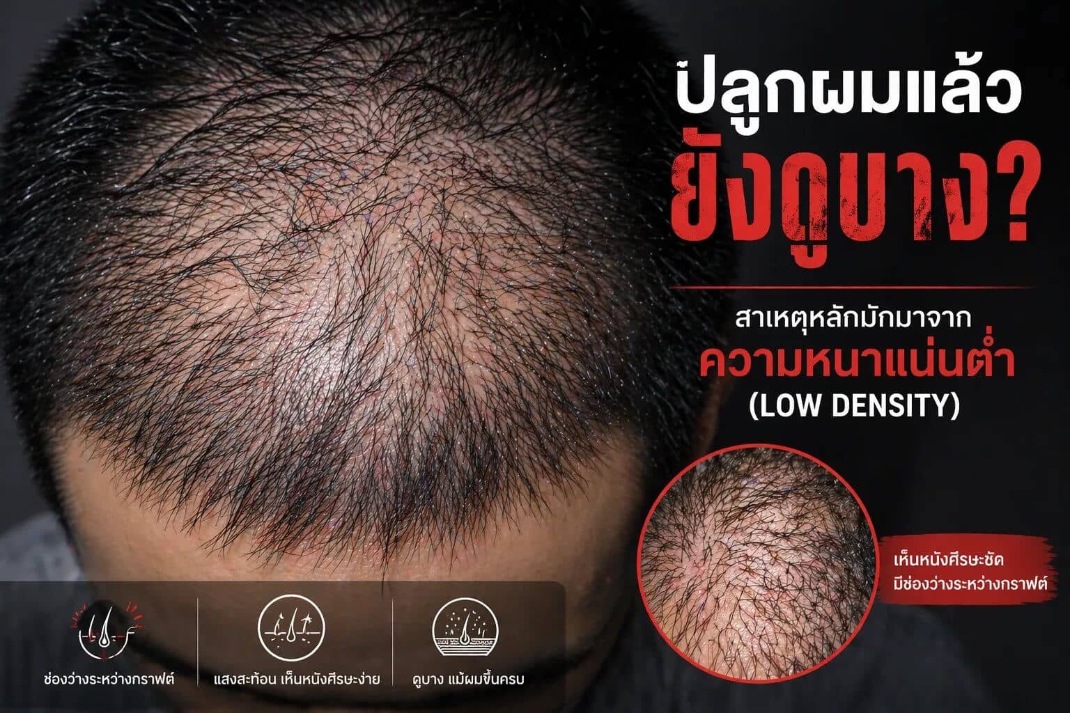 สาเหตุที่ปลูกผมแล้วยังดูบางจากปัญหา density และการวางกราฟต์