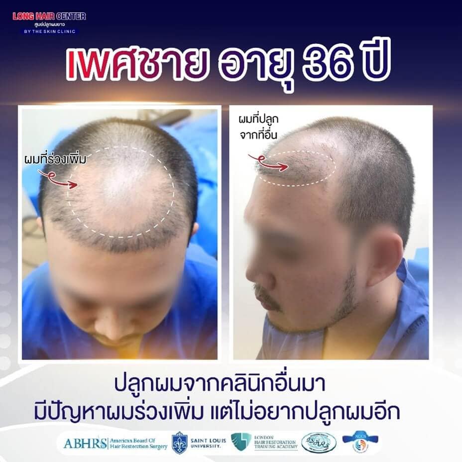 ตัวอย่างเคส The Skin Clinic กับการรักษาด้วยเทคนิค ALMI Nano Fat?