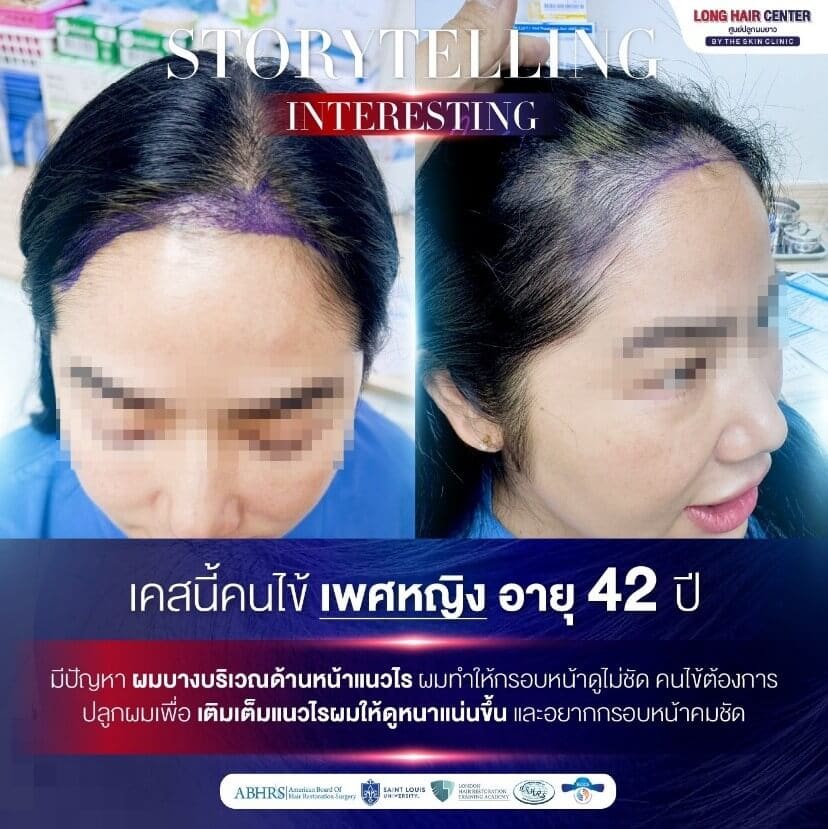 Interesting Case ปลูกผมผู้หญิง บนแนวผมเดิม