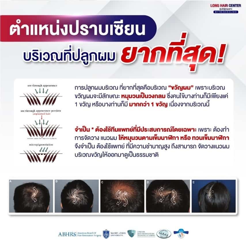 ศัลยกรรมปลูกผม, คลินิกปลูกผม