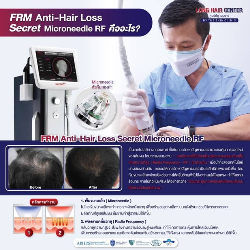 FRM (Fractional RF Microneedle)