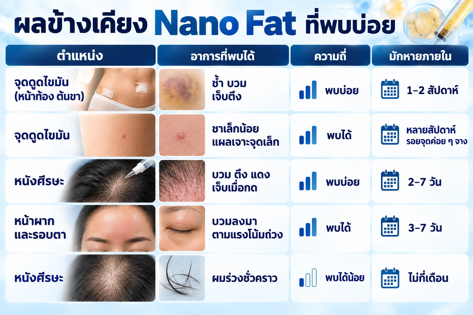 ตำแหน่งดูดไขมันและจุดฉีด Nano Fat ที่หนังศีรษะที่อาจมีอาการบวมช้ำช่วงแรก