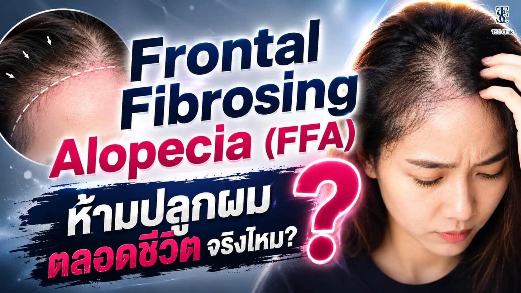 Frontal Fibrosing Alopecia (FFA) ห้ามปลูกผมตลอดชีวิตจริงไหม