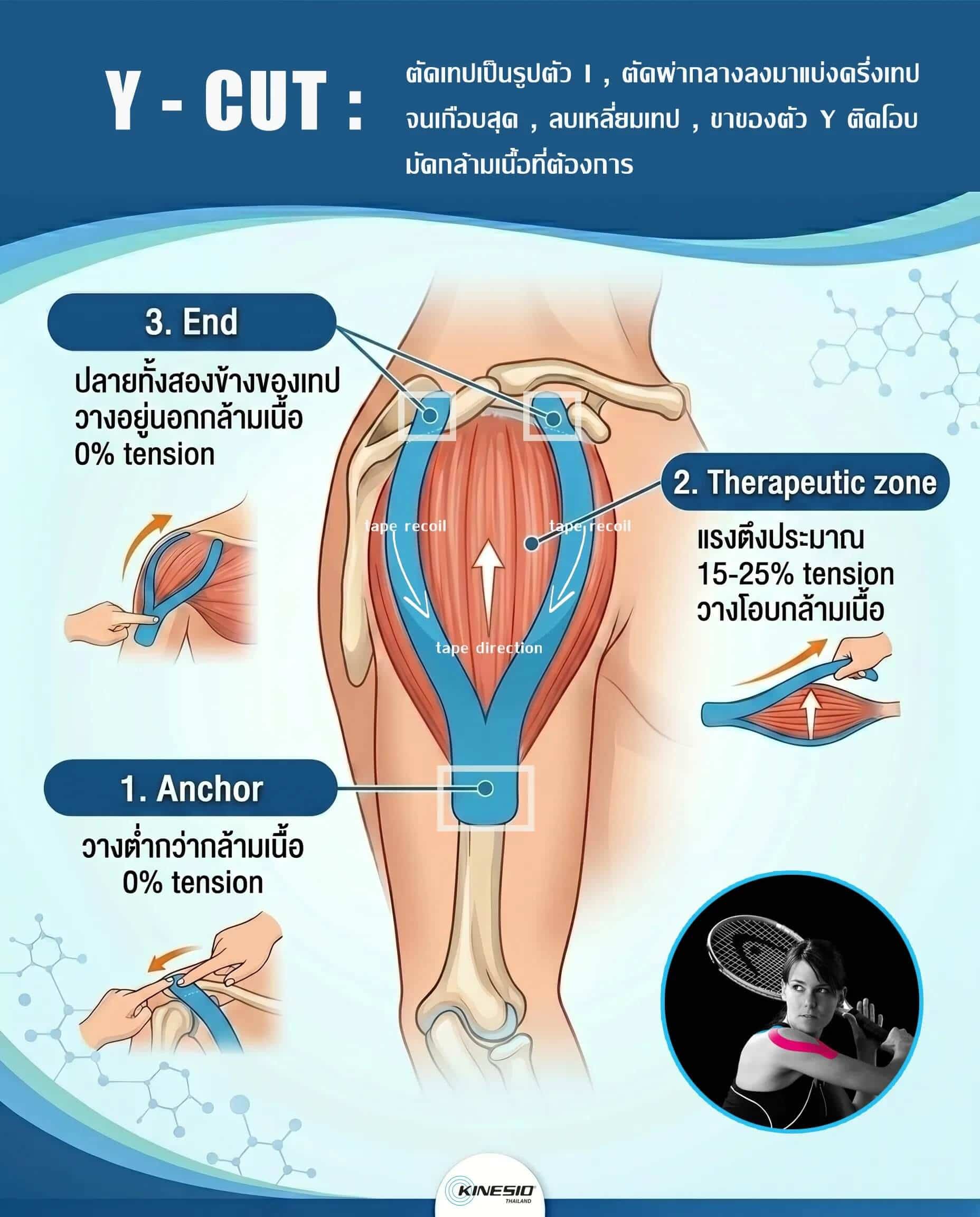 Y cut : การตัดเทปที่โอบล้อมรอบกล้ามเนื้อ