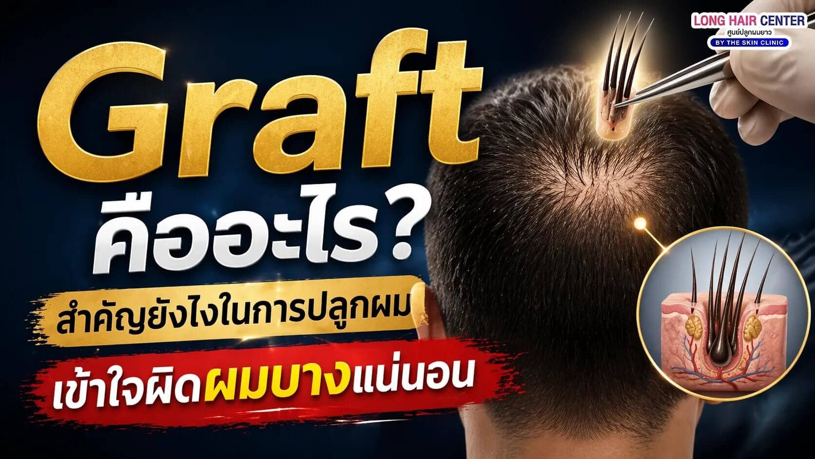 Graft คืออะไร? สำคัญยังไงในการปลูกผม | เข้าใจผิดผมบางแน่นอน