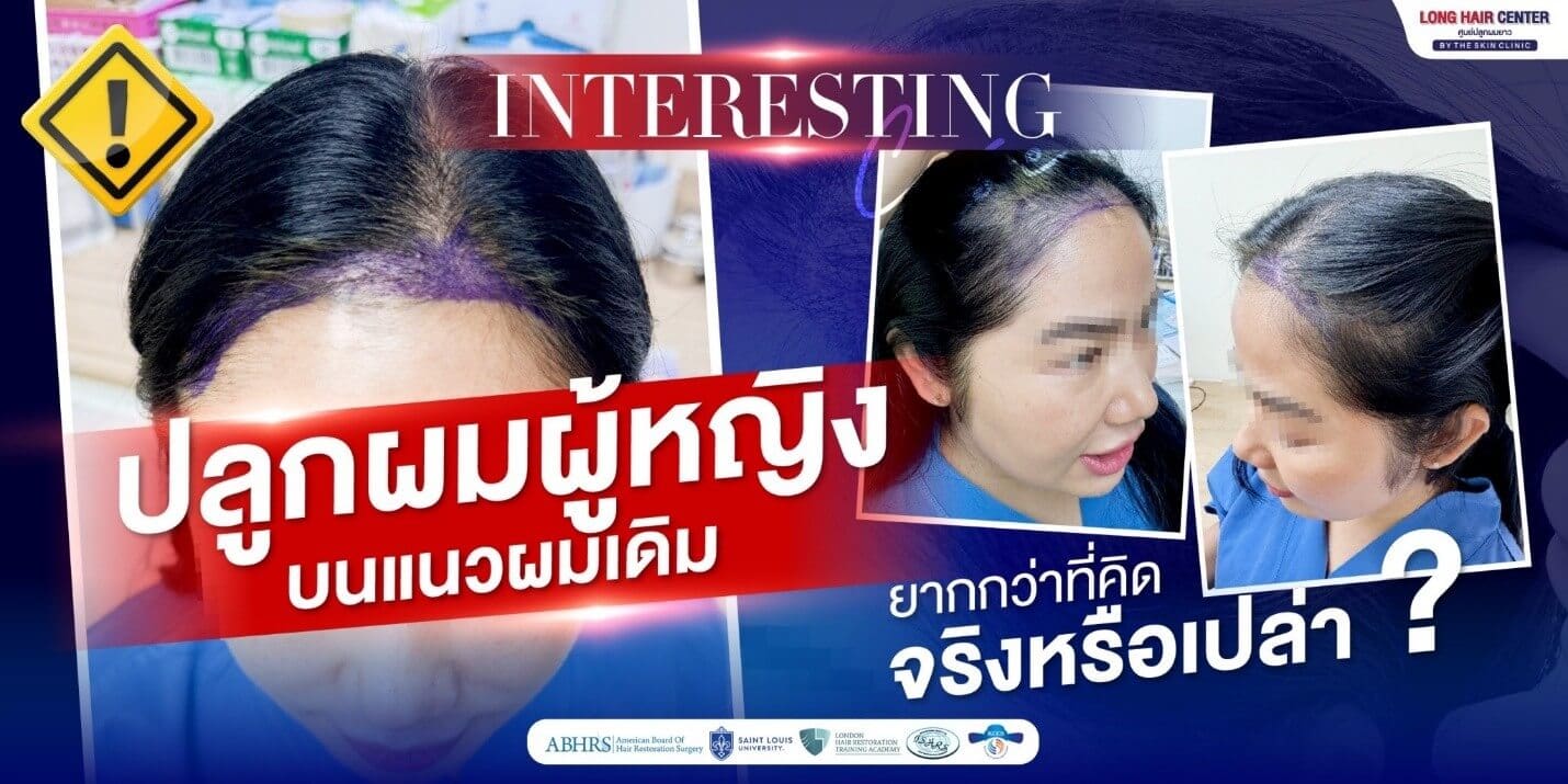 ปลูกผมผู้หญิง บนแนวผมเดิม ยากกว่าที่คิดจริงหรือเปล่า