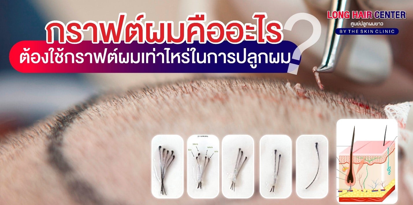 ปลูกผมแล้วต้องกินยาไปตลอดชีวิตหรือไม่?