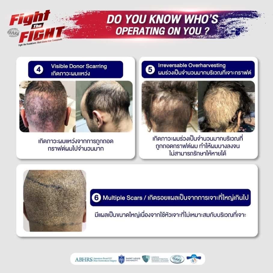 ศัลยกรรมปลูกผม, Hair Transplant