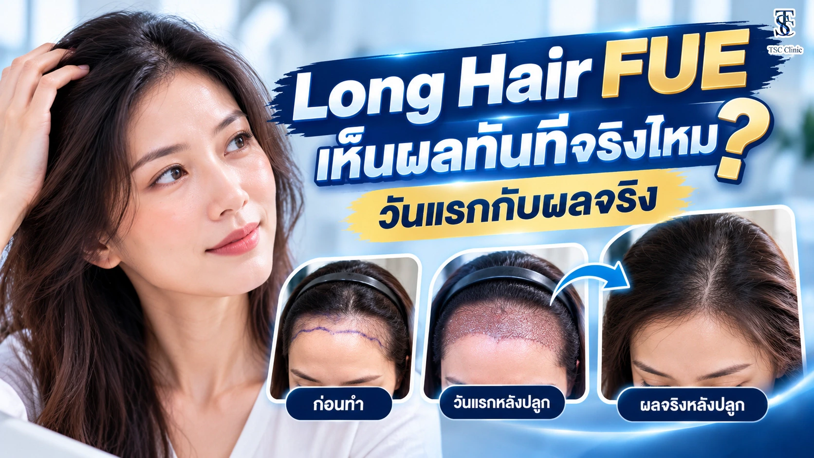 Long Hair FUE เห็นผลทันทีจริงไหม? วันแรกกับผลจริง